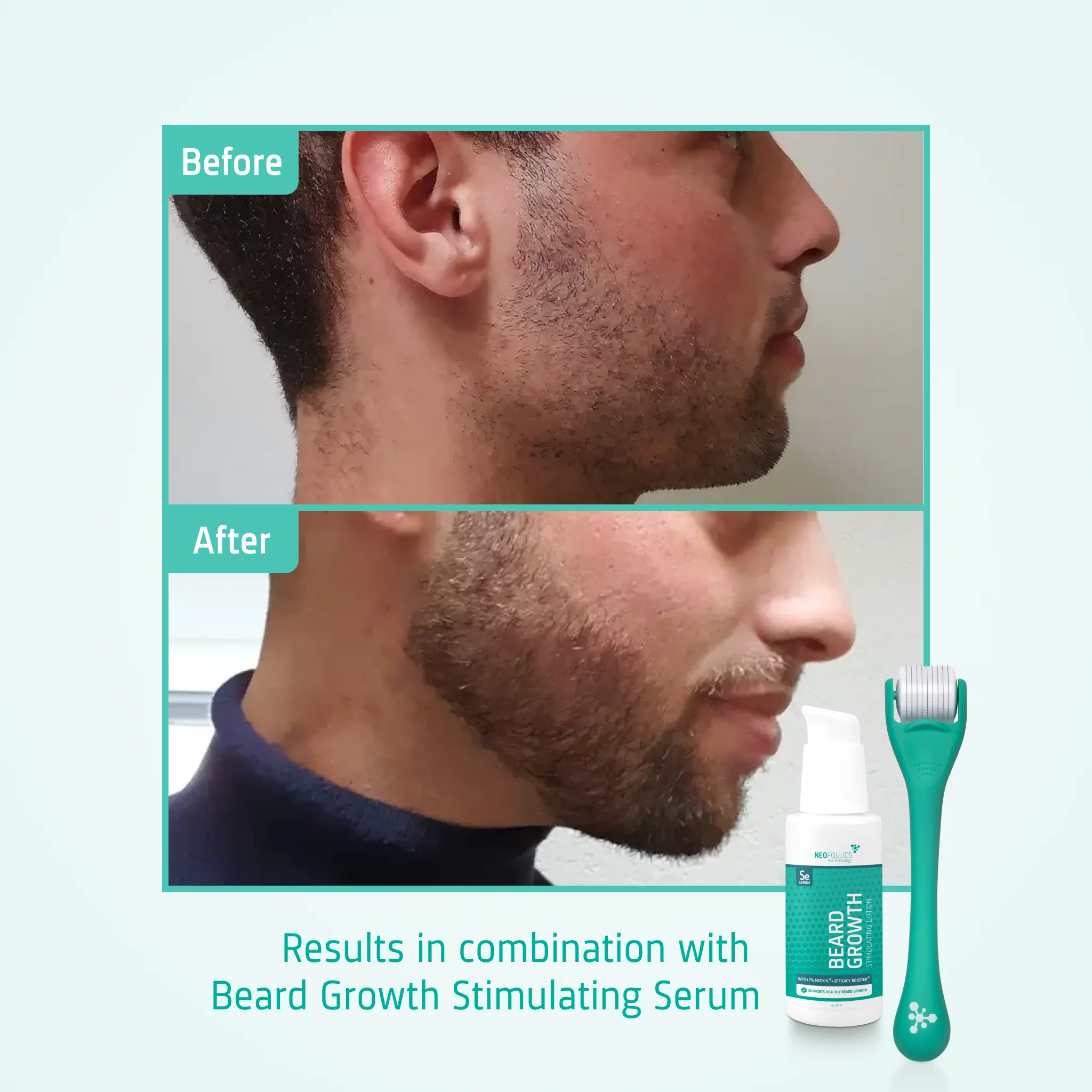 Beard Growth Enhancing Roller - Image 6