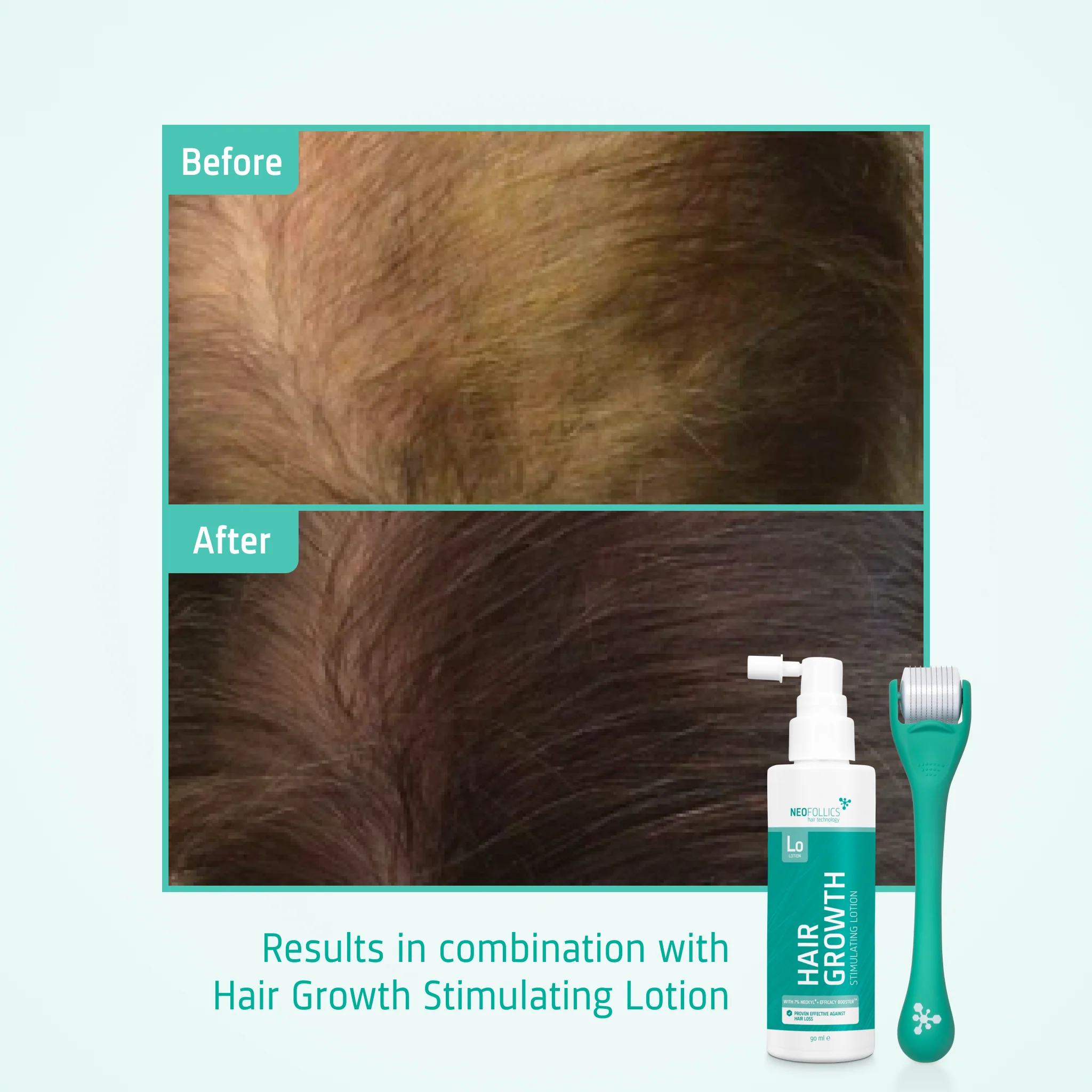 Hair Growth Enhancing Scalp Roller - Image 6
