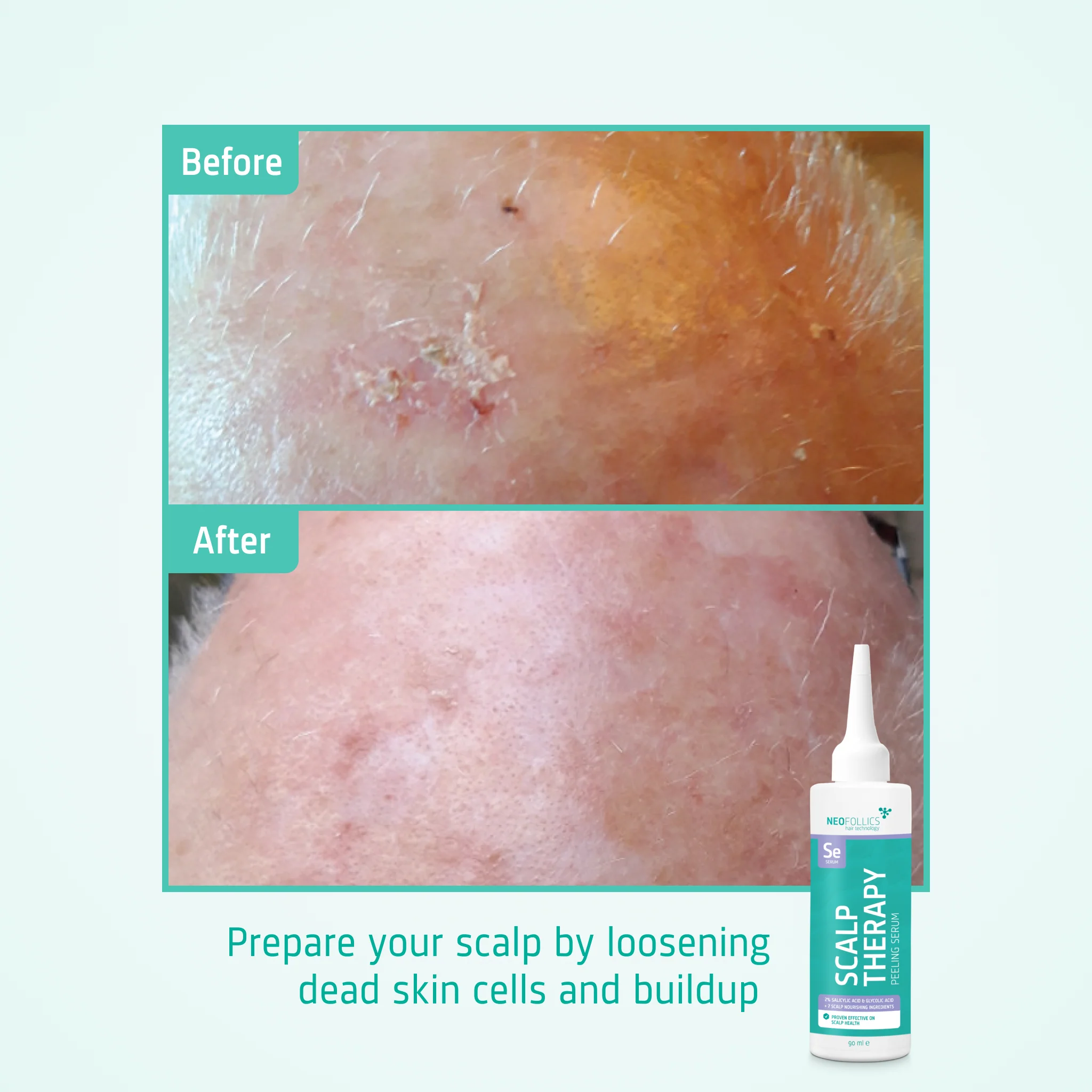 Scalp Therapy Peeling Serum - Image 5