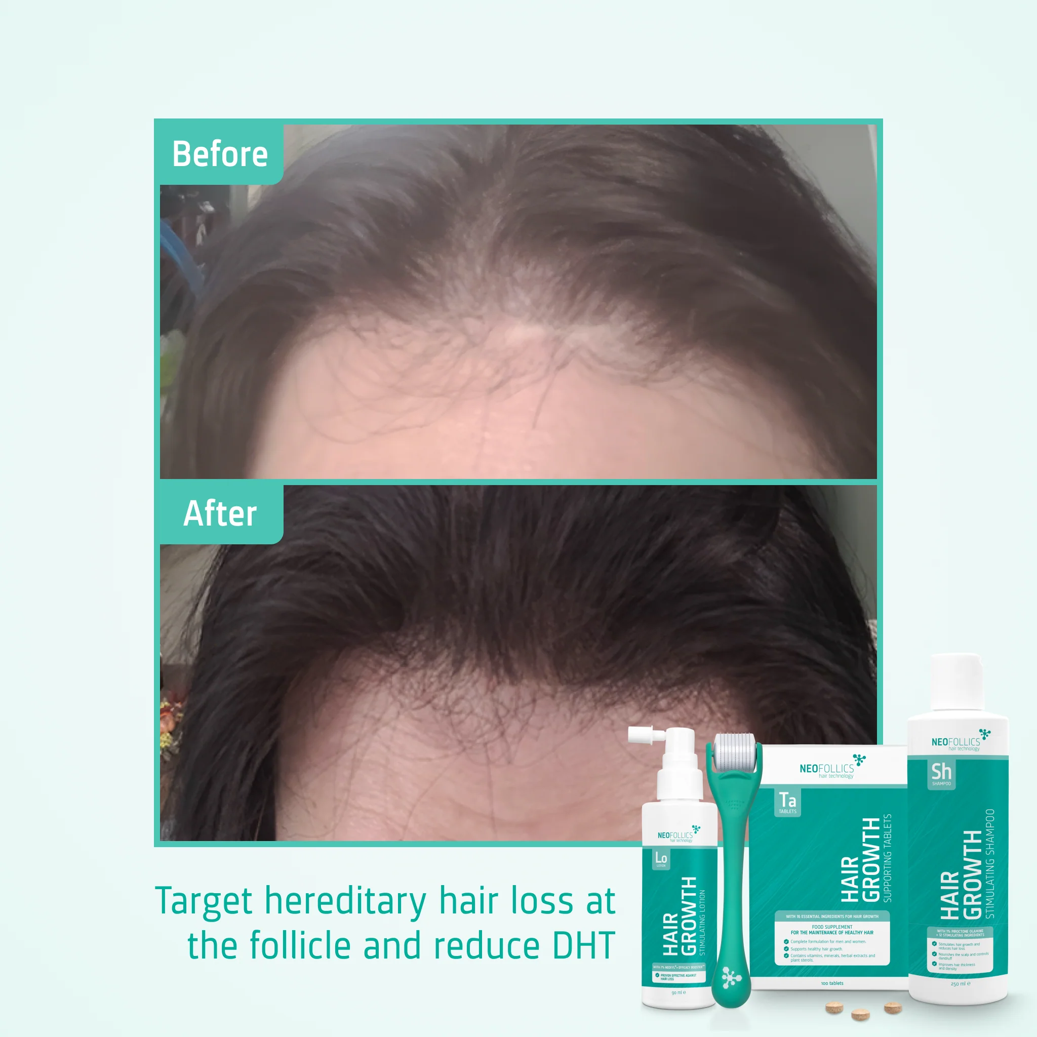 Androgenetic Alopecia treatment - Image 5