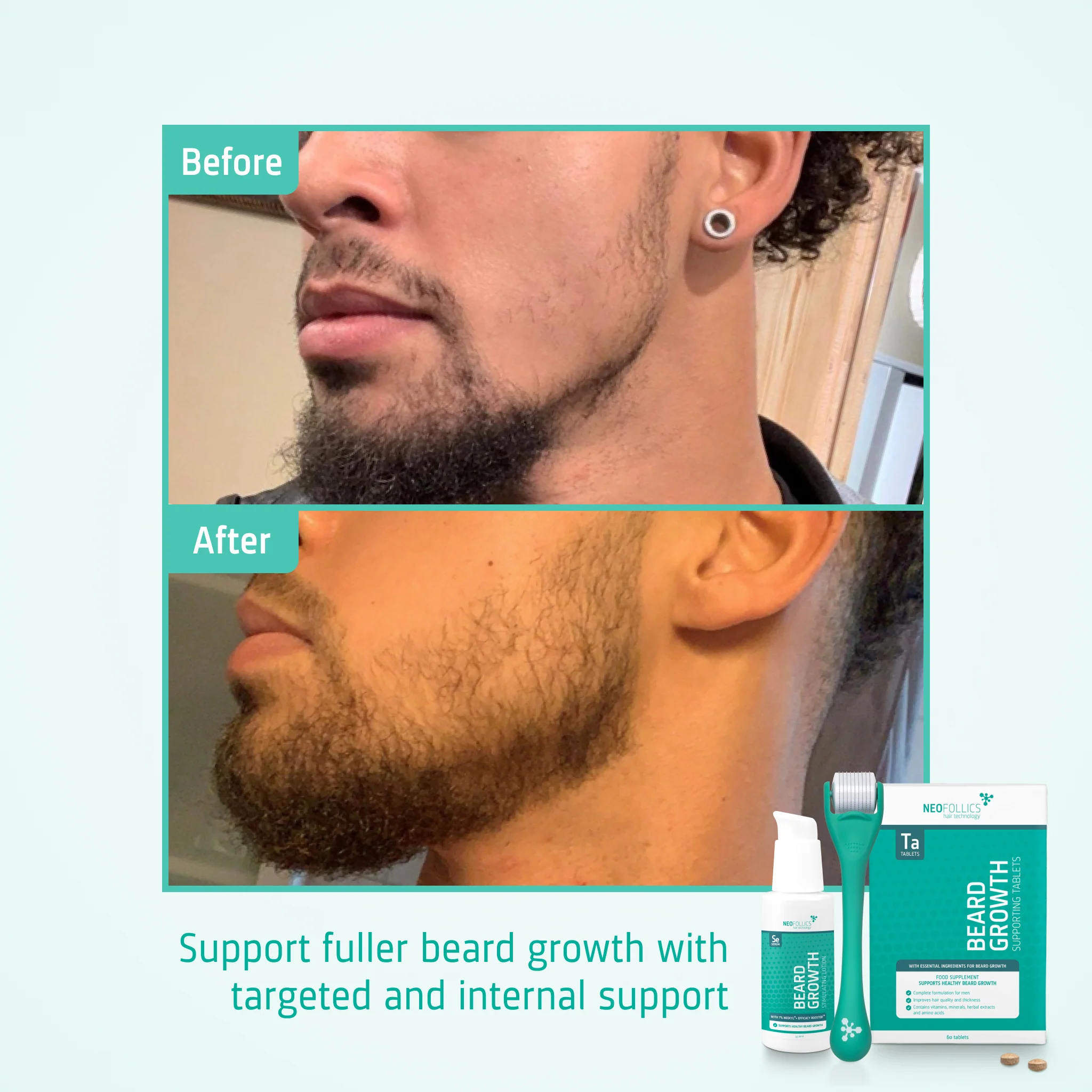 Beard Growth treatment - Image 5