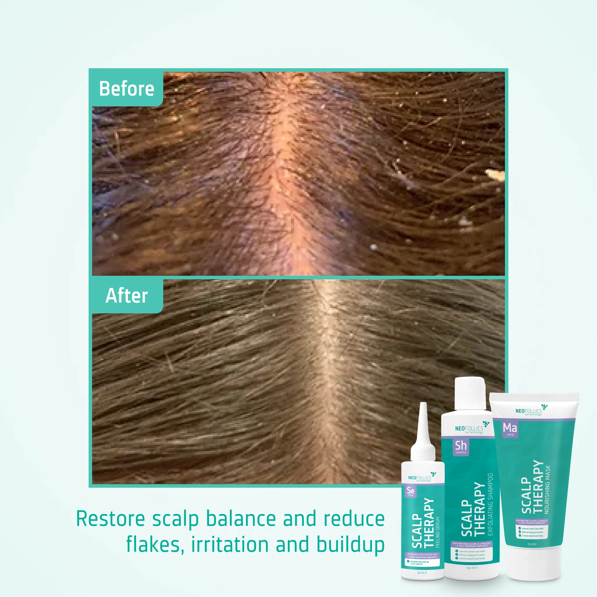 Neofollics Healthy Scalp treatment - Image 5